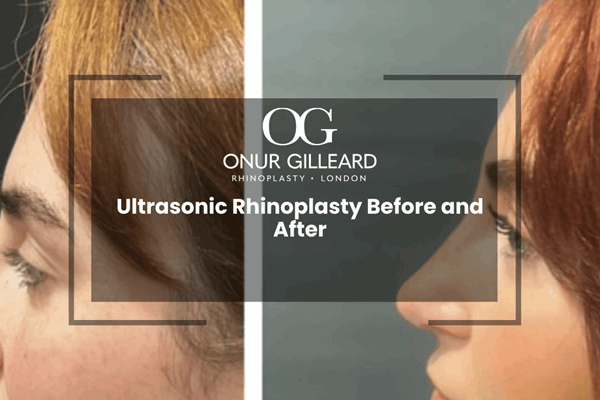 Ultrasonic Rhinoplasty Before and After