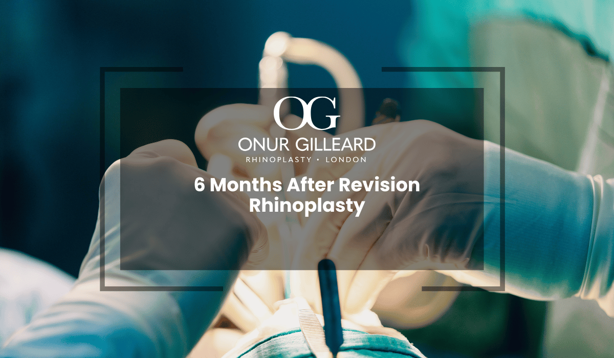6 Months After Revision Rhinoplasty