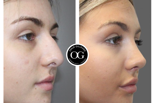 Faster recovery than other Rhinoplasty procedures