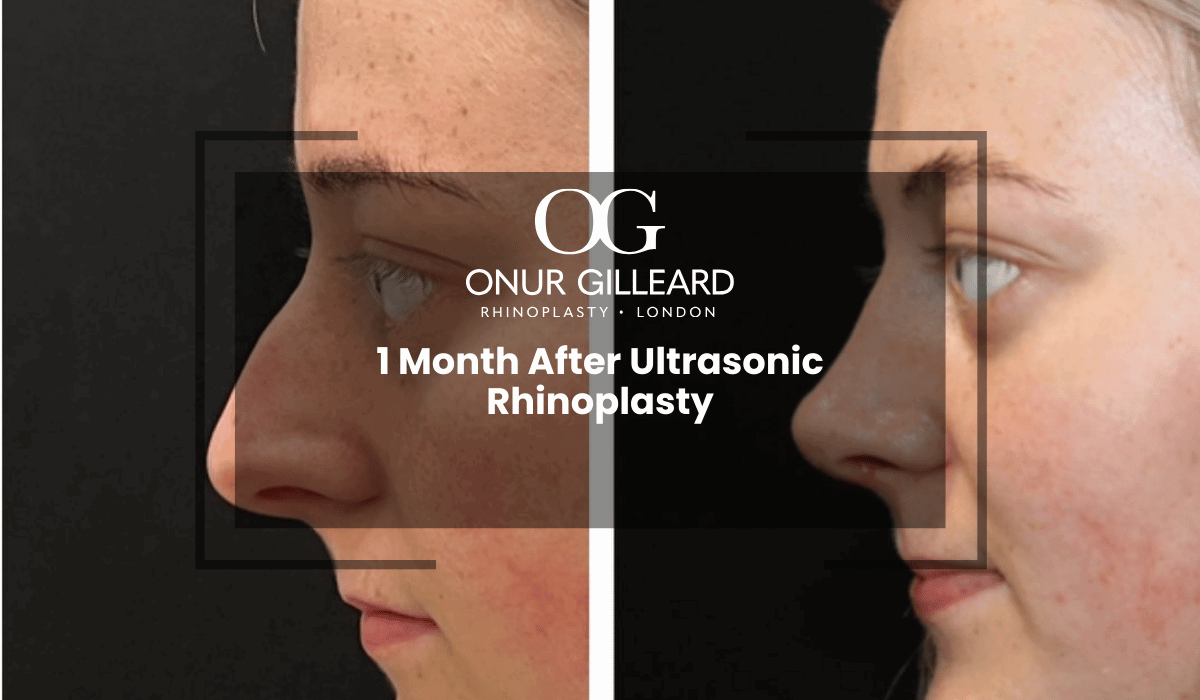 can i take glutathione after rhinoplasty skincare and how to recover Is glutathione IV drip necessary