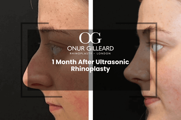 1 Month After Ultrasonic Rhinoplasty