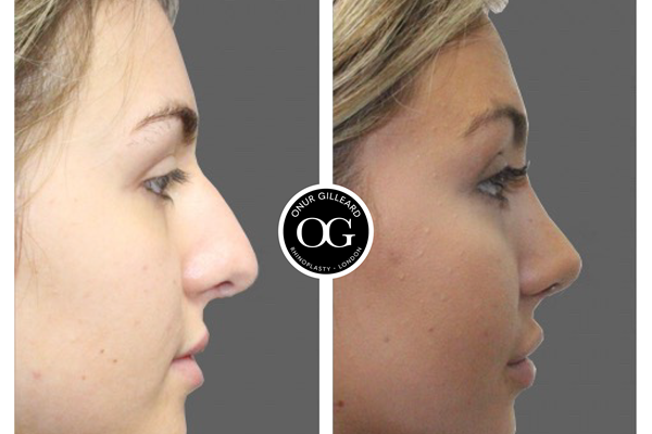 Precision sculpting and contouring