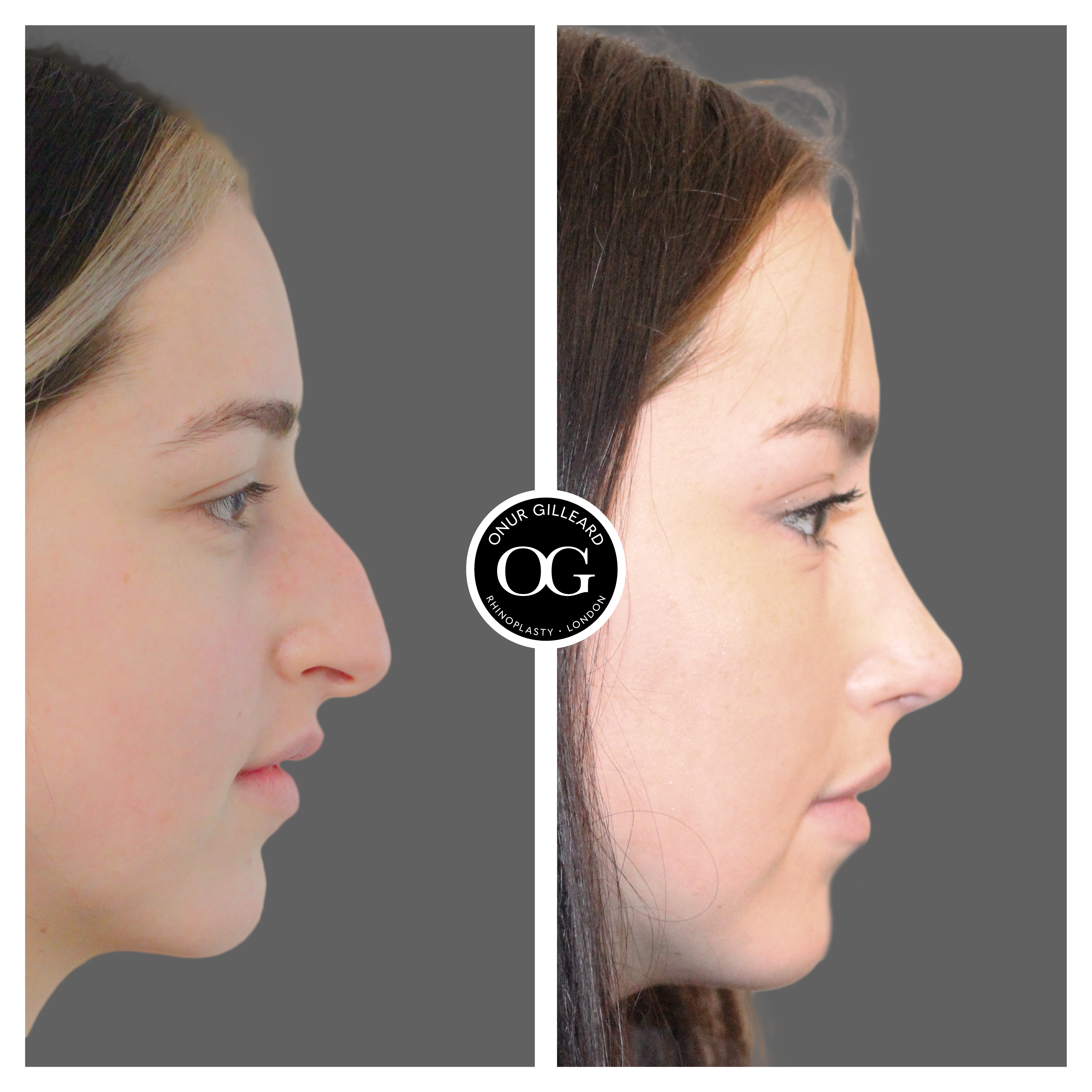 Ultrasonic Rhinoplasty