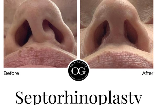 What is Septorhinoplasty?