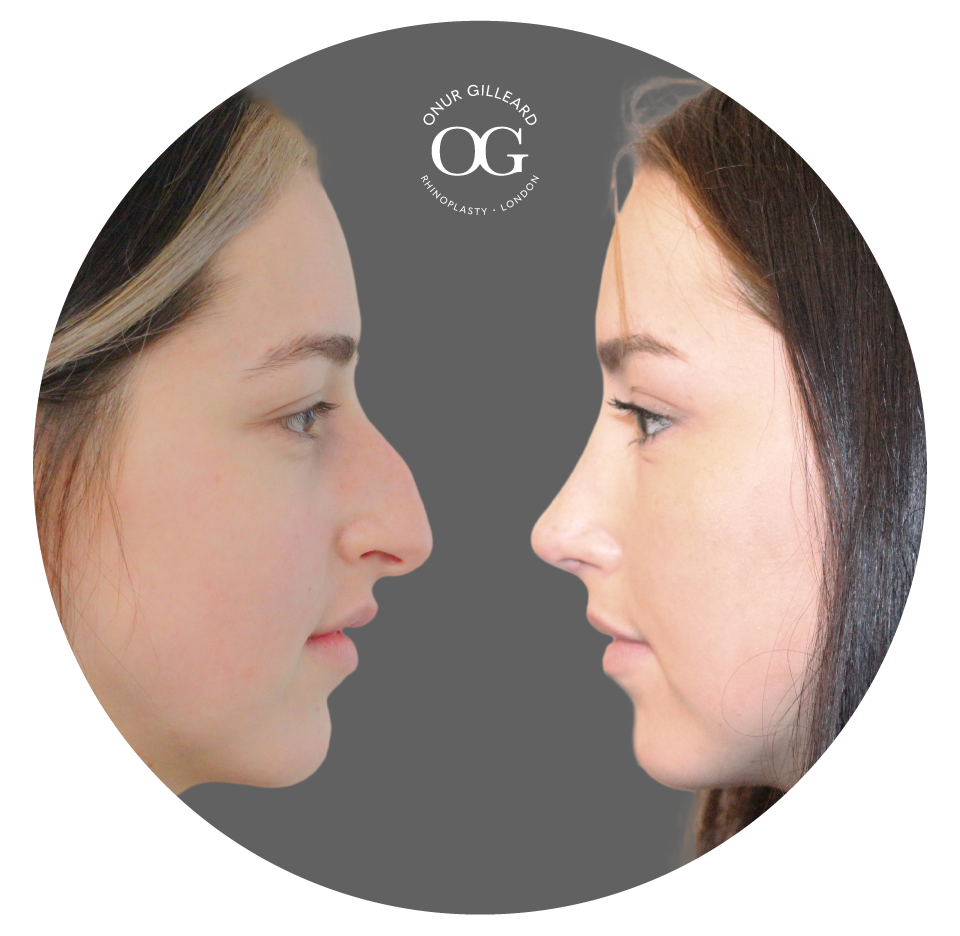Ultrasonic Rhinoplasty Result