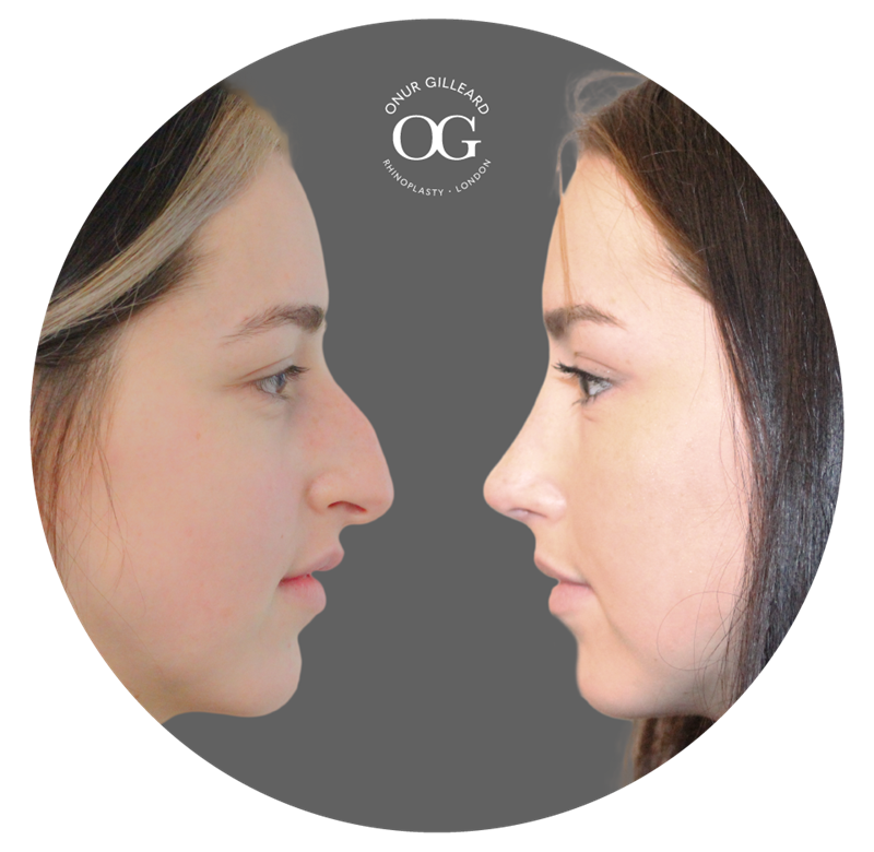 Ultrasonic Rhinoplasty Result