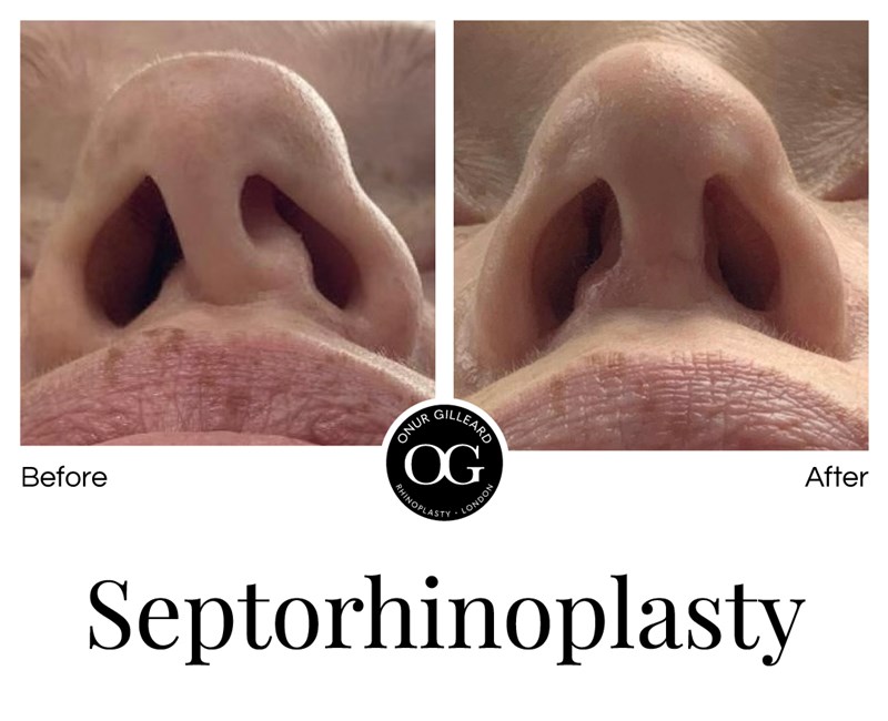 Septorhinoplasty Before and After by Dr. Onur Gilleard